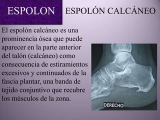 ESPOLON ESPOLÓN CALCÁNEO
El espolón calcáneo es una
prominencia ósea que puede
aparecer en la parte anterior
del talón (calcáneo) como
consecuencia de estiramientos
excesivos y continuados de la
fascia plantar, una banda de
tejido conjuntivo que recubre
los músculos de la zona.
 