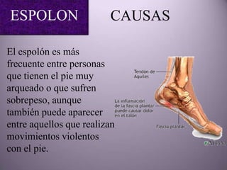ESPOLON                  CAUSAS

El espolón es más
frecuente entre personas
que tienen el pie muy
arqueado o que sufren
sobrepeso, aunque
también puede aparecer
entre aquellos que realizan
movimientos violentos
con el pie.
 