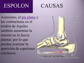 ESPOLON                   CAUSAS
Asimismo, el pie plano y
las contracturas en el
tendón de Aquiles
también aumentan la
tensión en la fascia
plantar, por lo que
pueden acarrear la
aparición de espolones
calcáneos.
 