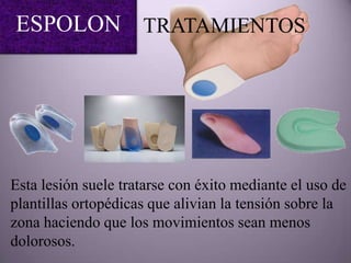 ESPOLON TRATAMIENTOS




Esta lesión suele tratarse con éxito mediante el uso de
plantillas ortopédicas que alivian la tensión sobre la
zona haciendo que los movimientos sean menos
dolorosos.
 