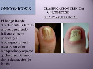 ONICOMICOSIS             CLASIFICACIÓN CLÍNICA:
                           ONICOMICOSIS
                         BLANCA SUPERFICIAL.
El hongo invade
directamente la lámina
ungueal, pudiendo
infectar el lecho
ungueal y el
hiponiquio. La uña
muestra un color
blanquecino y aspecto
quebradizo. Se puede
dar la destrucción de
la uña.
 