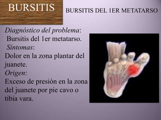 BURSITIS           BURSITIS DEL 1ER METATARSO


Diagnóstico del problema:
 Bursitis del 1er metatarso.
 Síntomas:
Dolor en la zona plantar del
juanete.
Origen:
Exceso de presión en la zona
del juanete por pie cavo o
tibia vara.
 