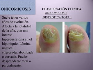 ONICOMICOSIS            CLASIFICACIÓN CLÍNICA:
                         ONICOMICOSIS
Suele tener varios      DISTRÓFICA TOTAL.
años de evolución.
Afecta a la totalidad
de la uña, con una
intensa
hiperqueratosis en el
hiponiquio. Lámina
ungueal
engrosada, abombada
o curvada. Puede
desprenderse total o
parcialmente.
 