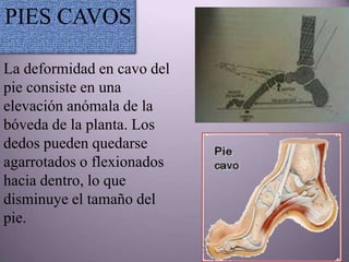 PIES CAVOS

La deformidad en cavo del
pie consiste en una
elevación anómala de la
bóveda de la planta. Los
dedos pueden quedarse
agarrotados o flexionados
hacia dentro, lo que
disminuye el tamaño del
pie.
 