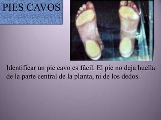 PIES CAVOS




Identificar un pie cavo es fácil. El pie no deja huella
de la parte central de la planta, ni de los dedos.
 