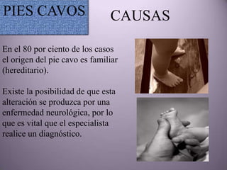 PIES CAVOS                     CAUSAS

En el 80 por ciento de los casos
el origen del pie cavo es familiar
(hereditario).

Existe la posibilidad de que esta
alteración se produzca por una
enfermedad neurológica, por lo
que es vital que el especialista
realice un diagnóstico.
 