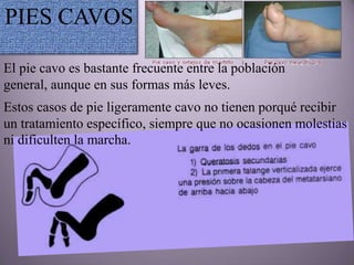 PIES CAVOS

El pie cavo es bastante frecuente entre la población
general, aunque en sus formas más leves.
Estos casos de pie ligeramente cavo no tienen porqué recibir
un tratamiento específico, siempre que no ocasionen molestias
ni dificulten la marcha.
 