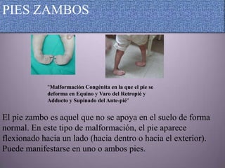 PIES ZAMBOS




             "Malformación Congénita en la que el pie se
             deforma en Equino y Varo del Retropié y
             Adducto y Supinado del Ante-pié"


El pie zambo es aquel que no se apoya en el suelo de forma
normal. En este tipo de malformación, el pie aparece
flexionado hacia un lado (hacia dentro o hacia el exterior).
Puede manifestarse en uno o ambos pies.
 