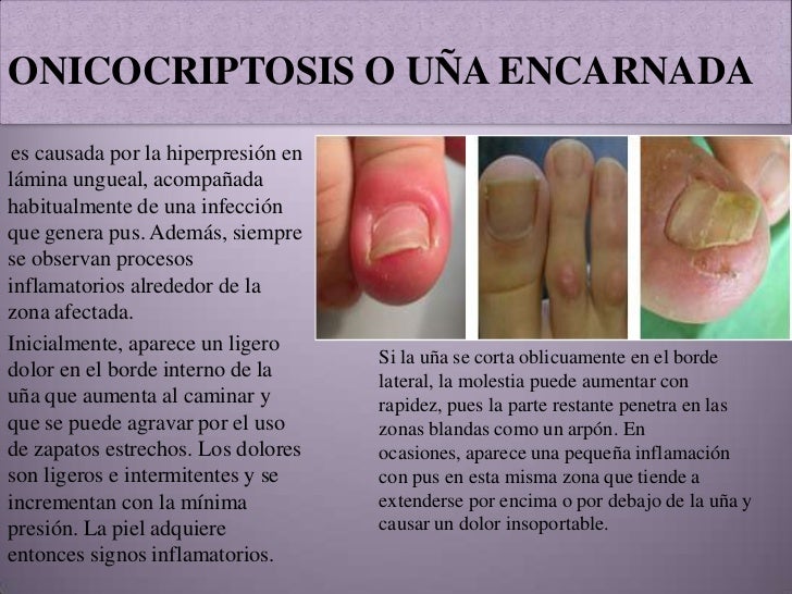 Rápidamente librarse del hongo de las uñas el foro