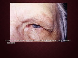 • Líneas gravitacionalesLíneas gravitacionales formadas x adelgazamiento progresivo =formadas x adelgazamiento progresivo =
piel laxapiel laxa
 