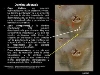 Dentina afectada
•     Capa       túrbida:     los     procesos
      odontoblásticos están presentes y vivos.
      La dentina peritubular ya sí es evidente
      y, aunque la dentina intertubular está
      desmineralizada, las fibras colágenas no
      están desnaturalizadas y presentan sus
      bandas características.
•     Zona transparente(…): la dentina
      intertubular        está         también
      desmineralizada parcialmente. Hay una
      característica importante y es que los
      túbulos dentinarios están llenos de
      cristales de whitIoquita. Estos cristales
      son de gran tamaño y más resistentes al
      ataque ácido. Esta esclerosis tubular es
      la responsable de su aspecto
      transparente o translúcido.
•     Zona subtransparente: no es más que
      una zona de transición entre la zonza
      transparente y la dentina sana
      subyacente, por lo que encontramos
      menos calcificaciones intratubulares y
      más áreas de dentina no afectada.
Ceballos García L. Adhesión a dentina afectada por caries y dentina
      esclerótica. Av. Odontoestomatol 2004; 20-2: 71-78.


                                                                      (copia)
 