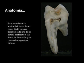 Anatomía…

 En el estudio de la
 anatomía interna de un
 molar lijado vamos a
 describir cada una de las
 partes destacando sus
 líneas de formación y las
 partes de un proceso
 carioso.
 