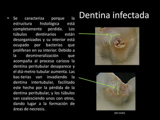 • Se     caracteriza     porque     la   Dentina infectada
  estructura      histológica    está
  completamente perdida. Los
  túbulos      dentinarios      están
  desorganizados y su interior está
  ocupado por bacterias que
  proliferan en su interior. Debido a
  la      desmineralización      que
  acompaña al proceso carioso la
  dentina peritubular desaparece y
  el diá-metro tubular aumenta. Las
  bac-terias van invadiendo la
  dentina intertubular, facilitado
  este hecho por la pérdida de la
  dentina peritubular, y los túbulos
  van coalesciendo unos con otros,
  dando lugar a la formación de
  áreas de necrosis.
                                                 (de revés)
 