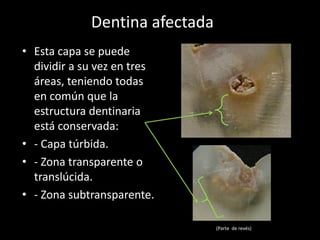 Dentina afectada
• Esta capa se puede
  dividir a su vez en tres
  áreas, teniendo todas
  en común que la
  estructura dentinaria
  está conservada:
• - Capa túrbida.
• - Zona transparente o
  translúcida.
• - Zona subtransparente.

                                (Parte de revés)
 