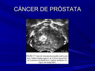 CÁNCER DE PRÓSTATA
 