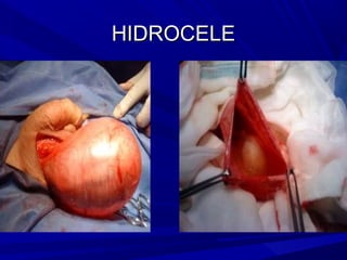 HIDROCELE
 