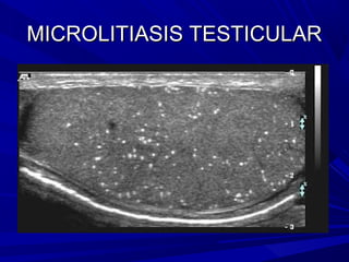 MICROLITIASIS TESTICULAR
 