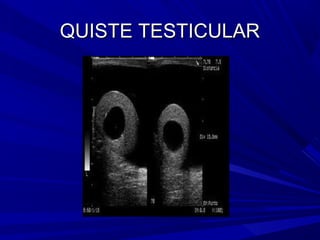 QUISTE TESTICULAR
 