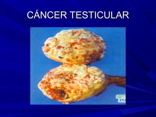CÁNCER TESTICULAR
 