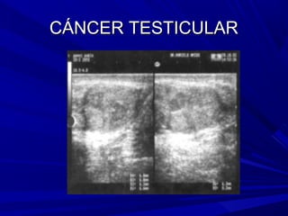 CÁNCER TESTICULAR
 