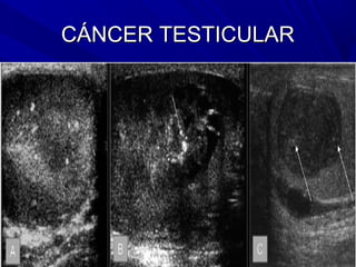 CÁNCER TESTICULAR
 