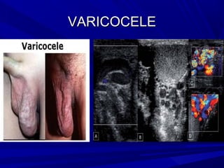 VARICOCELE
 