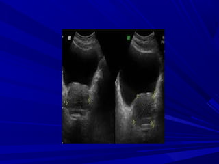 Enfermedades del Sistema Urinario