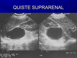 QUISTE SUPRARENAL
 