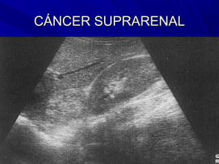 CÁNCER SUPRARENAL
 