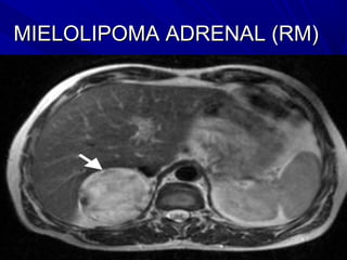 MIELOLIPOMA ADRENAL (RM)
 