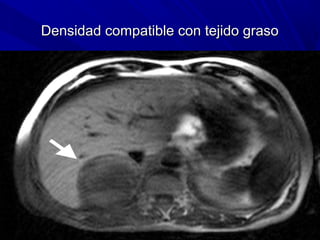 Densidad compatible con tejido graso
 
