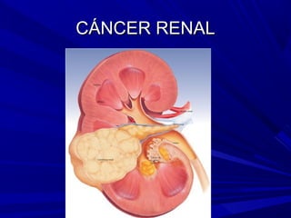 CÁNCER RENAL
 