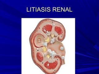 LITIASIS RENAL
 