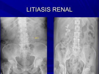 LITIASIS RENAL
 