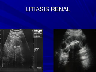 LITIASIS RENAL
 