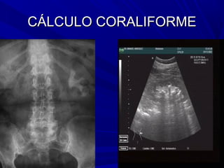 CÁLCULO CORALIFORME
 