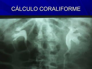CÁLCULO CORALIFORME
 