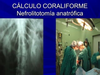 CÁLCULO CORALIFORME
 Nefrolitotomía anatrófica
 