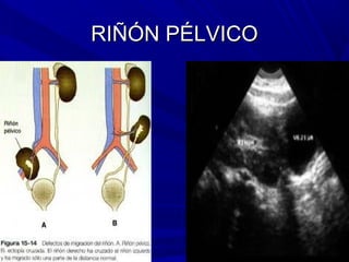 RIÑÓN PÉLVICO
 