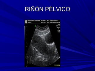 RIÑÓN PÉLVICO
 