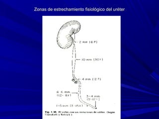 Zonas de estrechamiento fisiológico del uréter
 