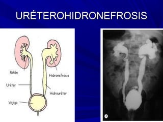 URÉTEROHIDRONEFROSIS
 