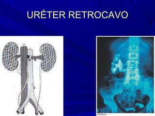 URÉTER RETROCAVO
 
