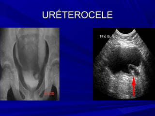 URÉTEROCELE
 