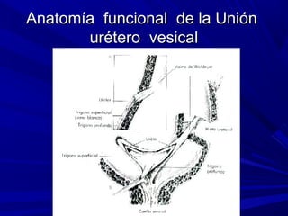 Anatomía funcional de la Unión
       urétero vesical
 
