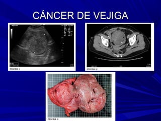CÁNCER DE VEJIGA
 