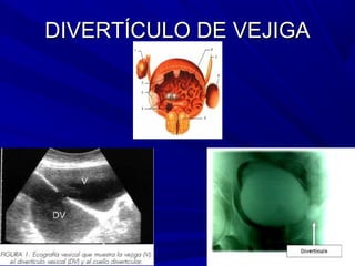 DIVERTÍCULO DE VEJIGA
 