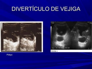 DIVERTÍCULO DE VEJIGA




Pólipo
 