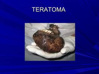 TERATOMA
 