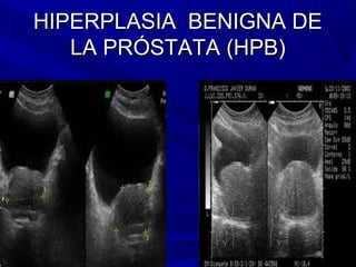 HIPERPLASIA BENIGNA DE
   LA PRÓSTATA (HPB)
 